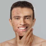 acne treatment martinsville acne treatment martinsville