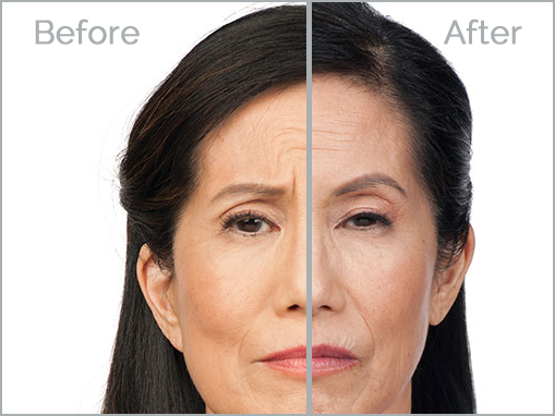 botox-1