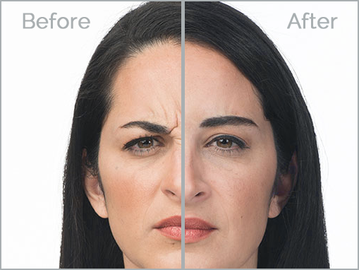 botox-2
