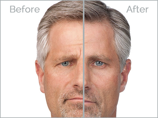 botox-3