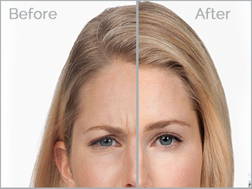 botox-4