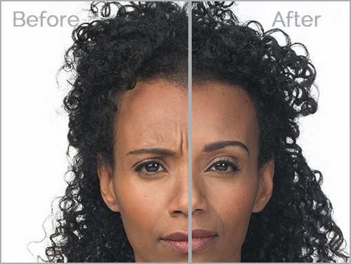 botox-5
