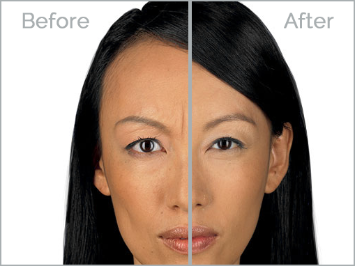 botox-6