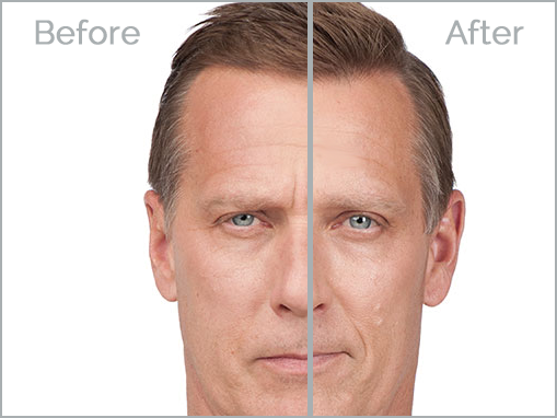 botox-7