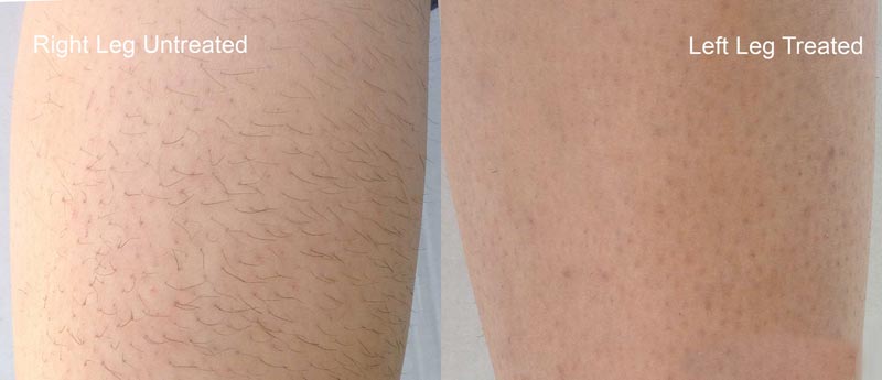 laser-hair-removal-1