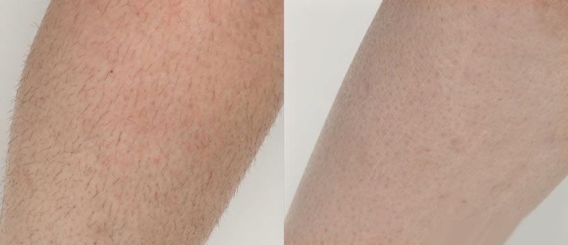 laser-hair-removal-2