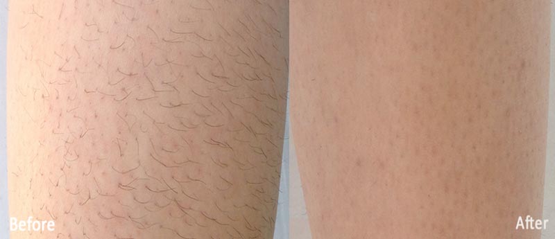 laser-hair-removal-3
