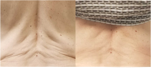 microneedling martinsville, va microneedling martinsville, va