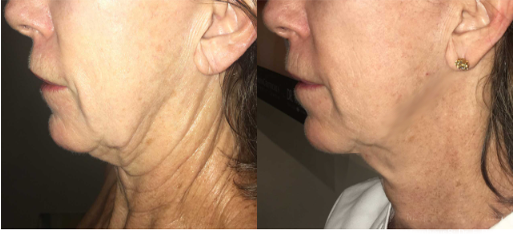 microneedling martinsville, va microneedling martinsville, va