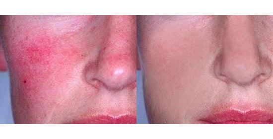 rosacea before after rosacea before after