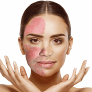 rosacea treatment martinsville rosacea treatment martinsville
